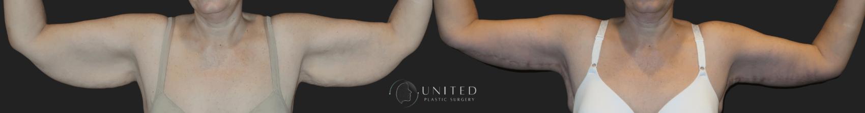 Before & After Arm & Thigh Lift Case 15 Front View in Newport Beach, Temecula, & Orange County, California