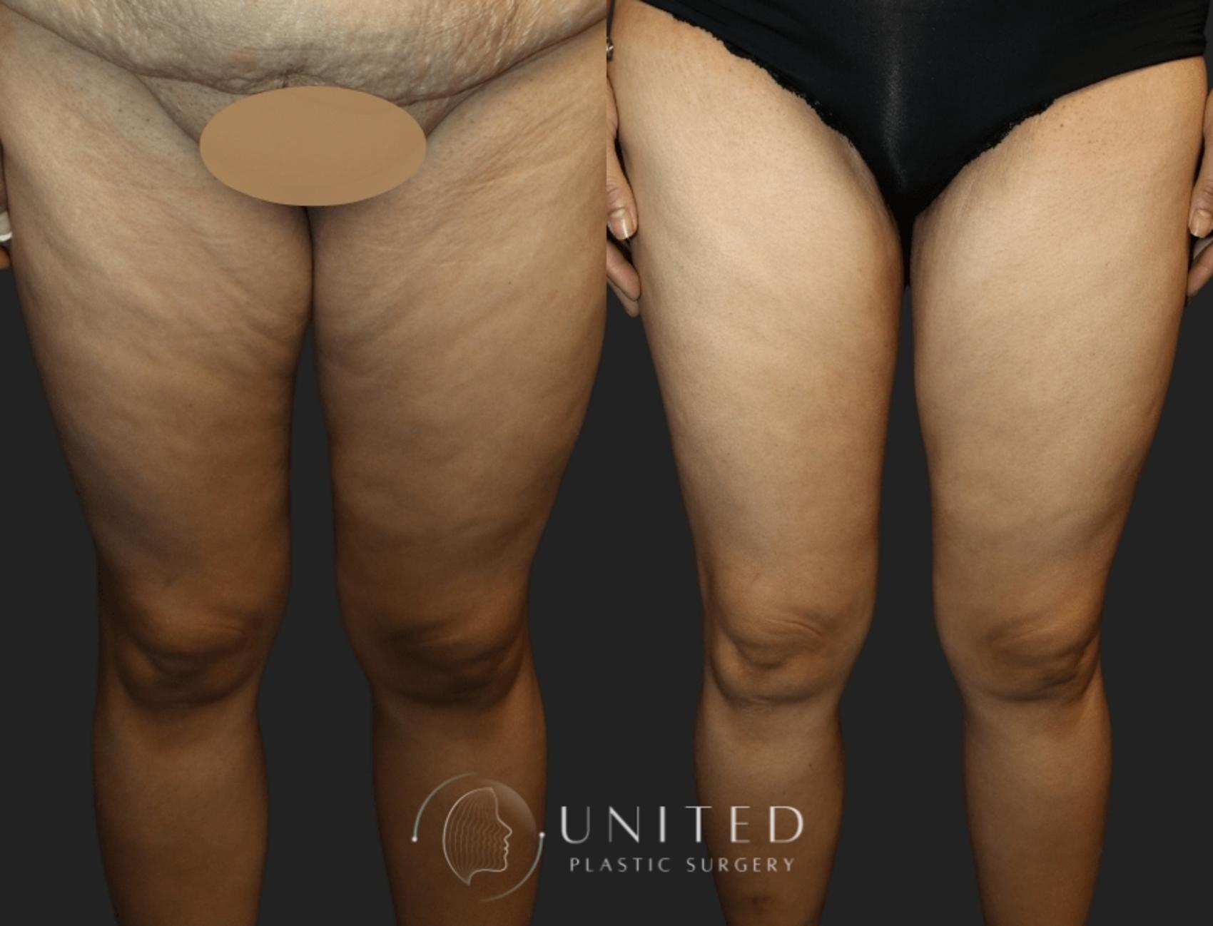 Before & After Arm & Thigh Lift Case 6 Front View in Newport Beach, Temecula, & Orange County, California