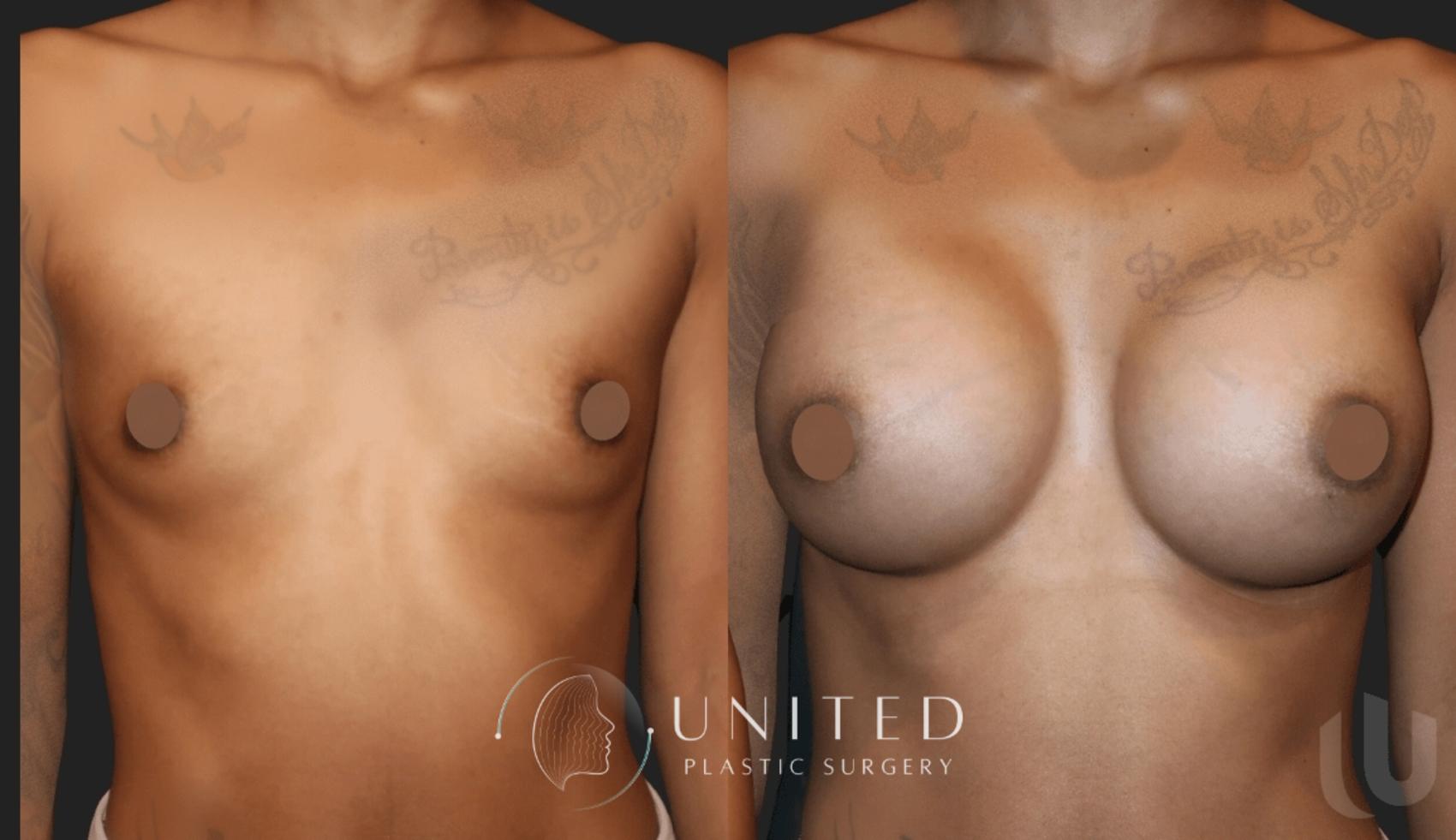 Before & After Breast Augmentation Case 13 Front View in Newport Beach, Temecula, & Orange County, California