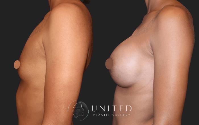 Before & After Breast Augmentation Case 13 Left Side View in Newport Beach, Temecula, & Orange County, California