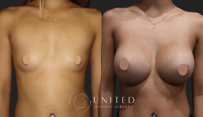 Before & After Breast Augmentation Case 19 Front View in Newport Beach, Temecula, & Orange County, California