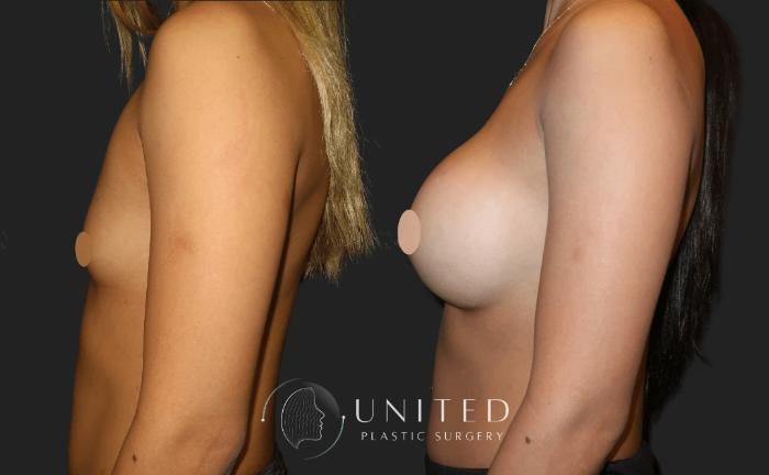 Before & After Breast Augmentation Case 19 Left Side View in Newport Beach, Temecula, & Orange County, California