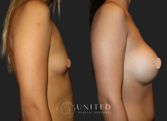 Before & After Breast Augmentation Case 19 Right Side View in Newport Beach, Temecula, & Orange County, California