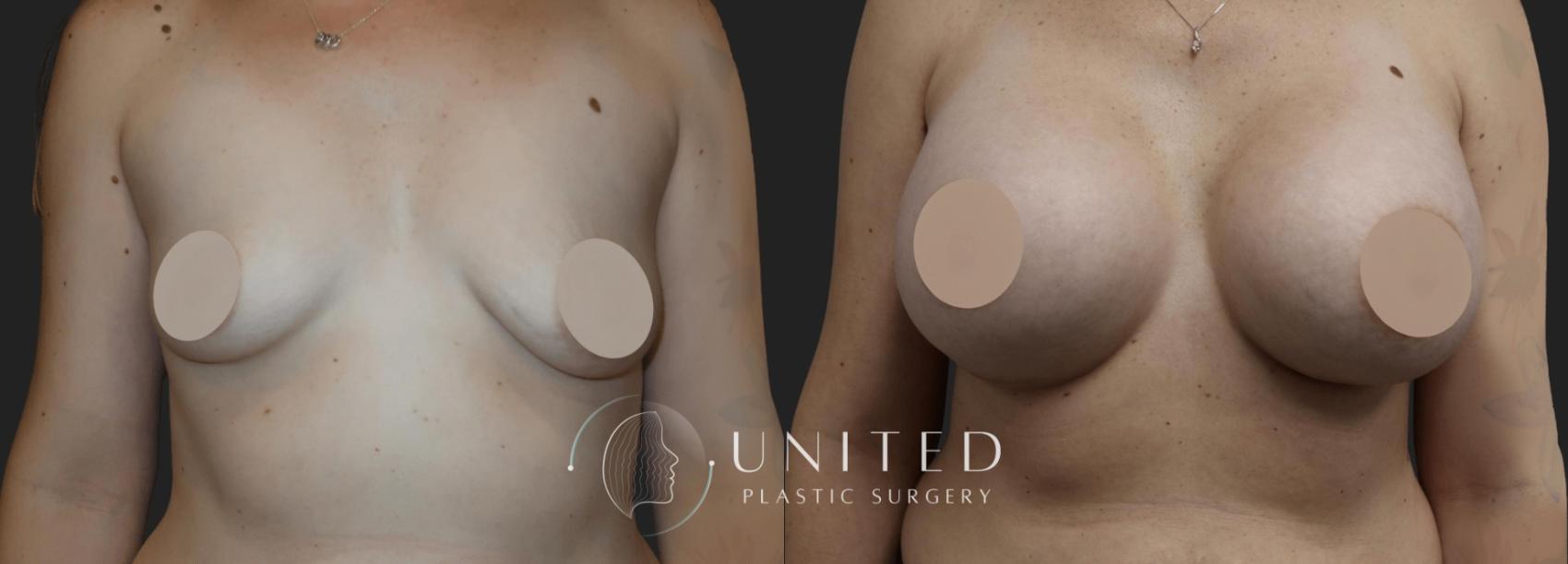 Before & After Breast Augmentation Case 20 Front View in Newport Beach, Temecula, & Orange County, California