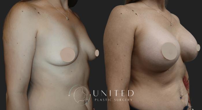 Before & After Breast Augmentation Case 20 Right Oblique View in Newport Beach, Temecula, & Orange County, California