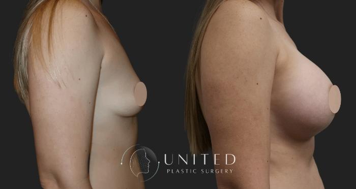 Before & After Breast Augmentation Case 20 Right Side View in Newport Beach, Temecula, & Orange County, California