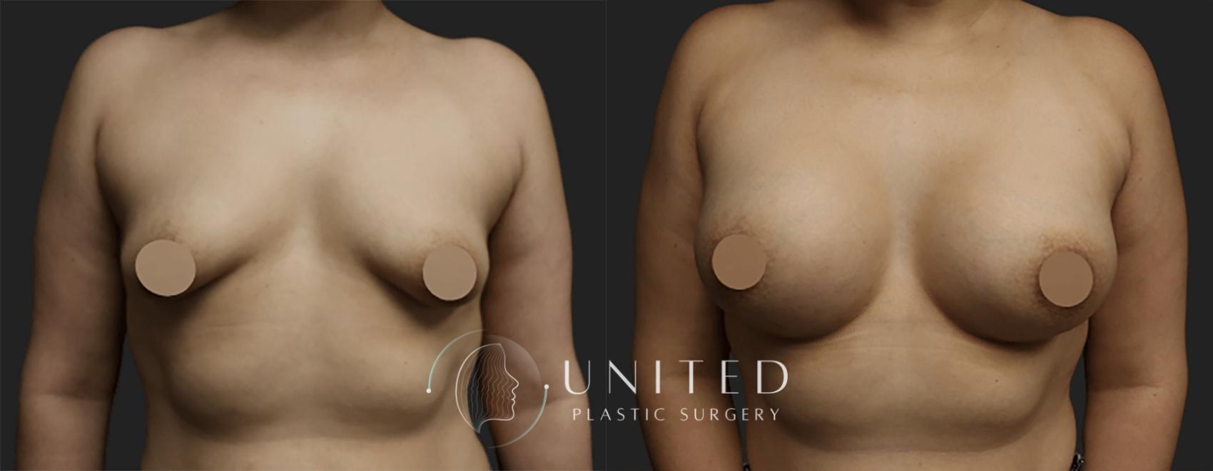 Before & After Breast Augmentation Case 5 Front View in Newport Beach, Temecula, & Orange County, California
