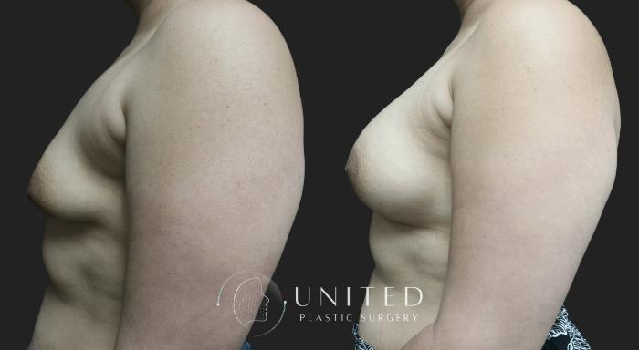 Before & After Breast Augmentation Case 5 Left Side View in Newport Beach, Temecula, & Orange County, California