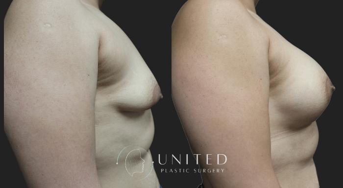 Before & After Breast Augmentation Case 5 Right Side View in Newport Beach, Temecula, & Orange County, California