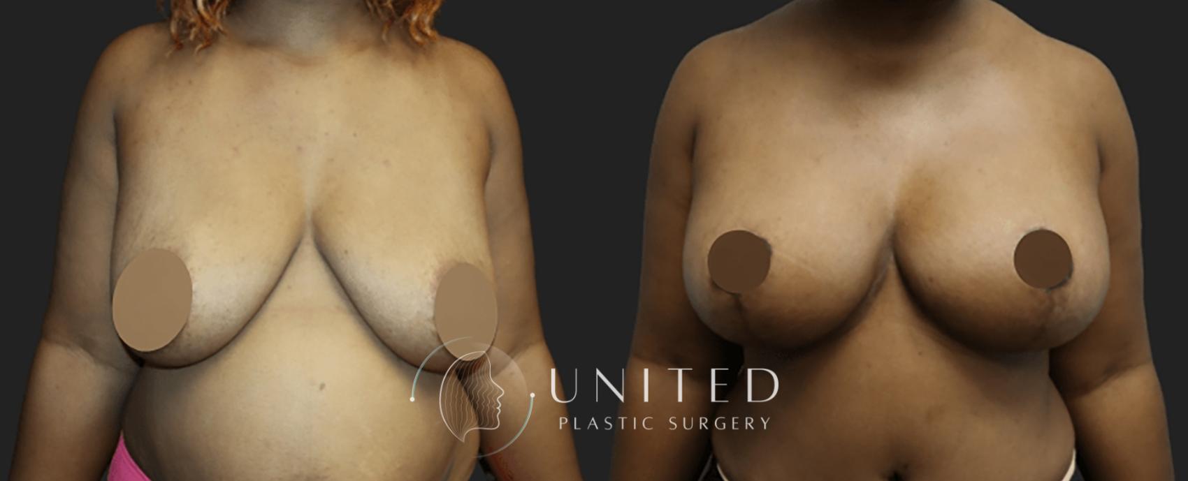 Before & After Breast Lift Case 1 Front View in Newport Beach, Temecula, & Orange County, California