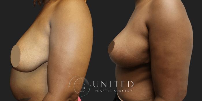 Before & After Breast Lift Case 1 Left Side View in Newport Beach, Temecula, & Orange County, California