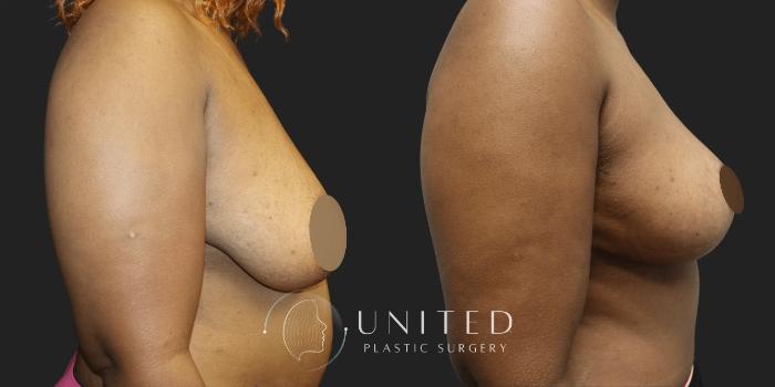 Before & After Breast Lift Case 1 Right Side View in Newport Beach, Temecula, & Orange County, California