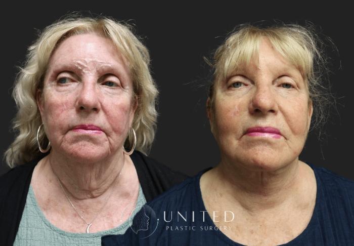 Before & After Facelift & Neck Lift Case 3 Front View in Newport Beach, Temecula, & Orange County, California