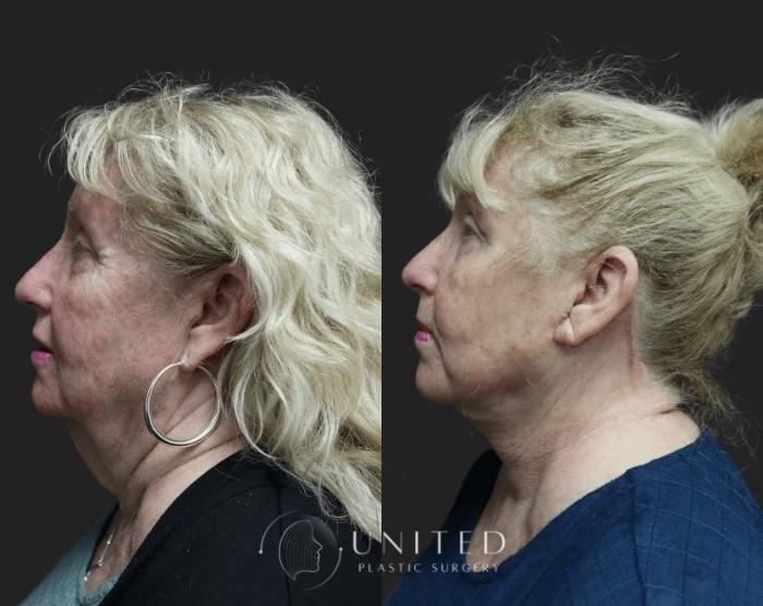Before & After Facelift & Neck Lift Case 3 Left Side View in Newport Beach, Temecula, & Orange County, California
