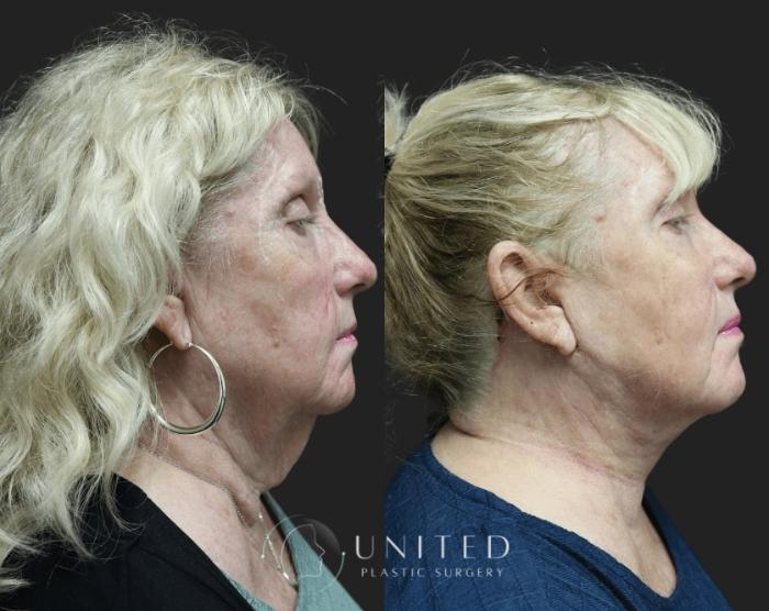 Before & After Facelift & Neck Lift Case 3 Right Side View in Newport Beach, Temecula, & Orange County, California