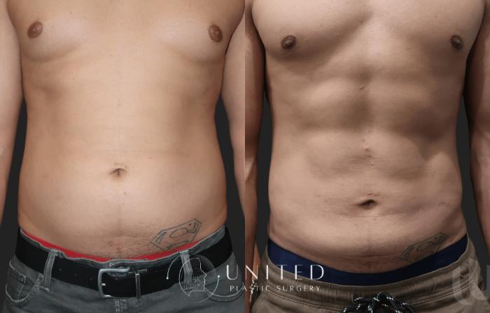 Before & After Liposuction Case 9 Front View in Newport Beach, Temecula, & Orange County, California