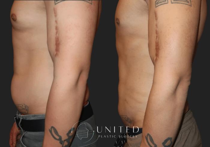 Before & After Liposuction Case 9 Left Side View in Newport Beach, Temecula, & Orange County, California