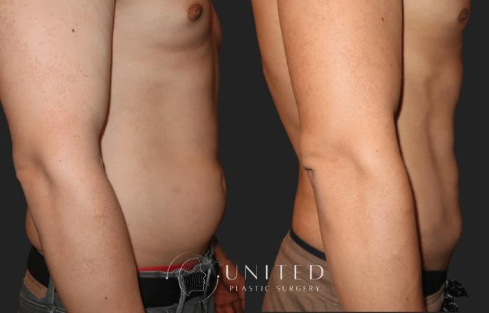Before & After Liposuction Case 9 Right Side View in Newport Beach, Temecula, & Orange County, California