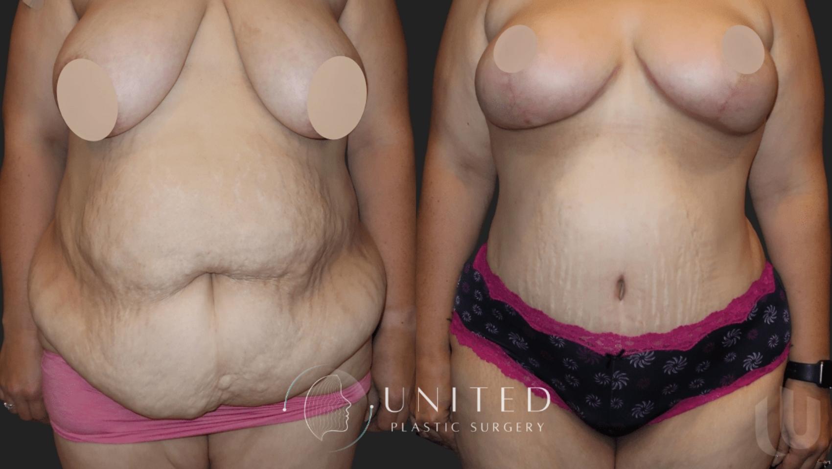 Before & After Mommy Makeover Case 12 Front View in Newport Beach, Temecula, & Orange County, California