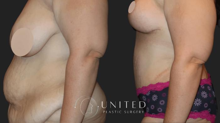 Before & After Mommy Makeover Case 12 Left Side View in Newport Beach, Temecula, & Orange County, California