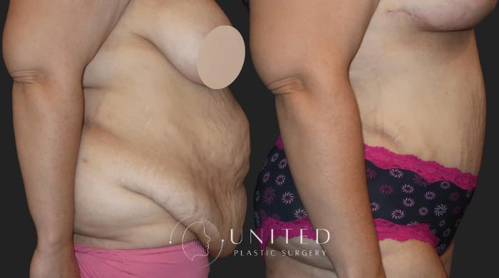 Before & After Mommy Makeover Case 12 Right Side View in Newport Beach, Temecula, & Orange County, California