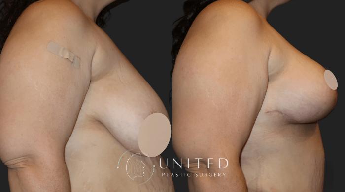 Before & After Mommy Makeover Case 12 Right Side Upper View in Newport Beach, Temecula, & Orange County, California