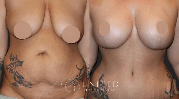 Before & After Breast Lift Case 18 Front View in Newport Beach, Temecula, & Orange County, California