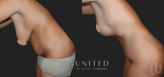 Before & After Breast Lift Case 18 Left Side View in Newport Beach, Temecula, & Orange County, California