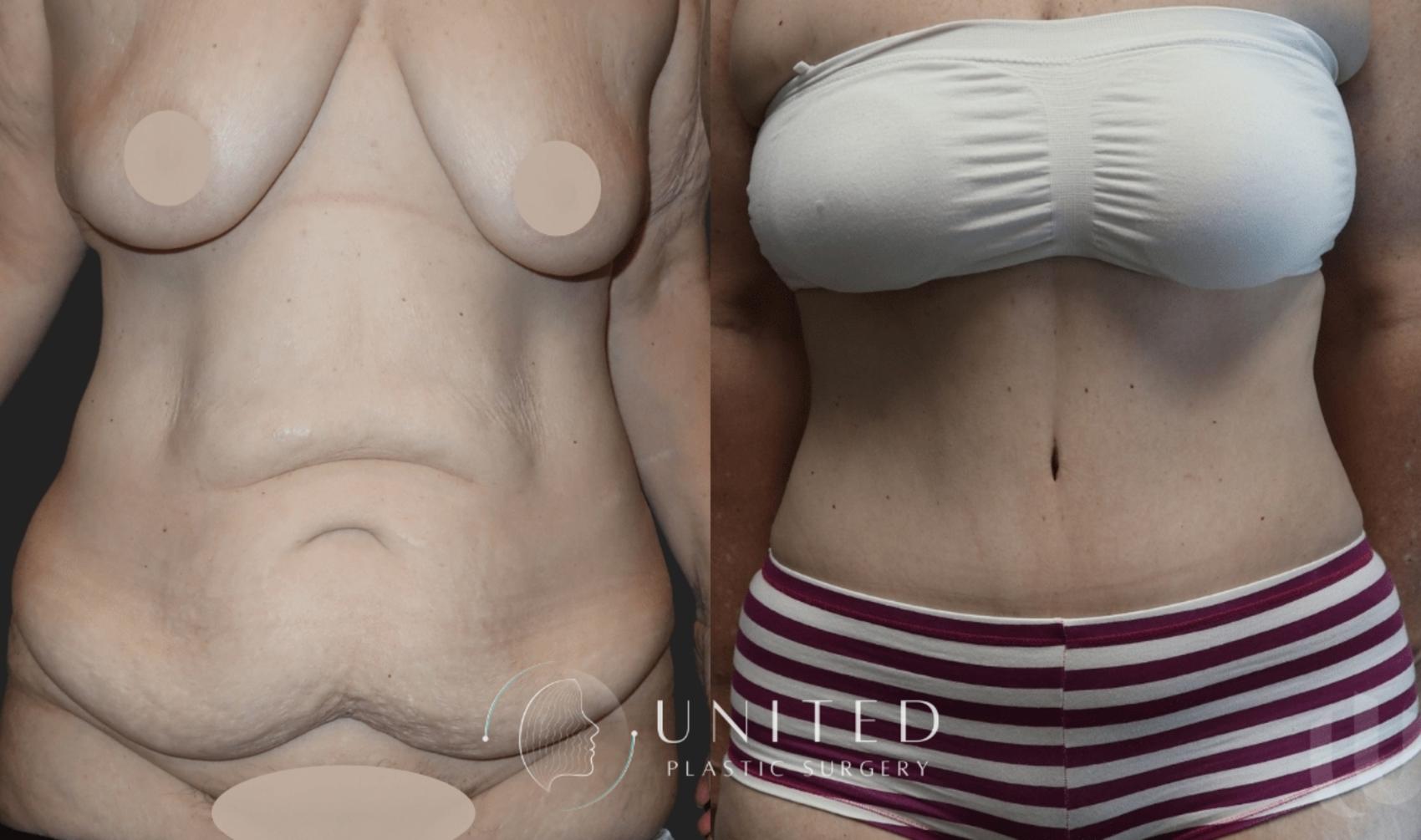Before & After Tummy Tuck Case 10 Front View in Newport Beach, Temecula, & Orange County, California