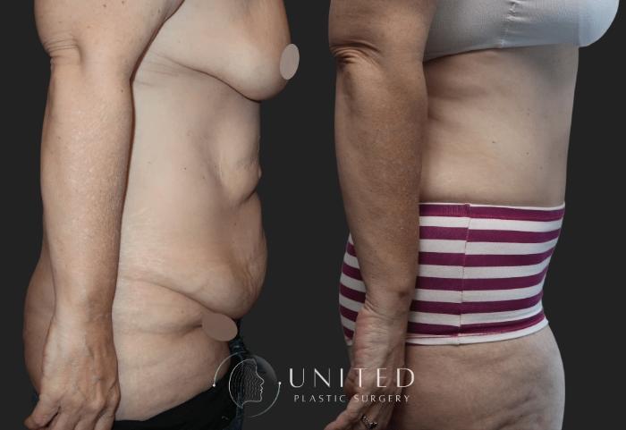 Before & After Tummy Tuck Case 10 Right Side View in Newport Beach, Temecula, & Orange County, California