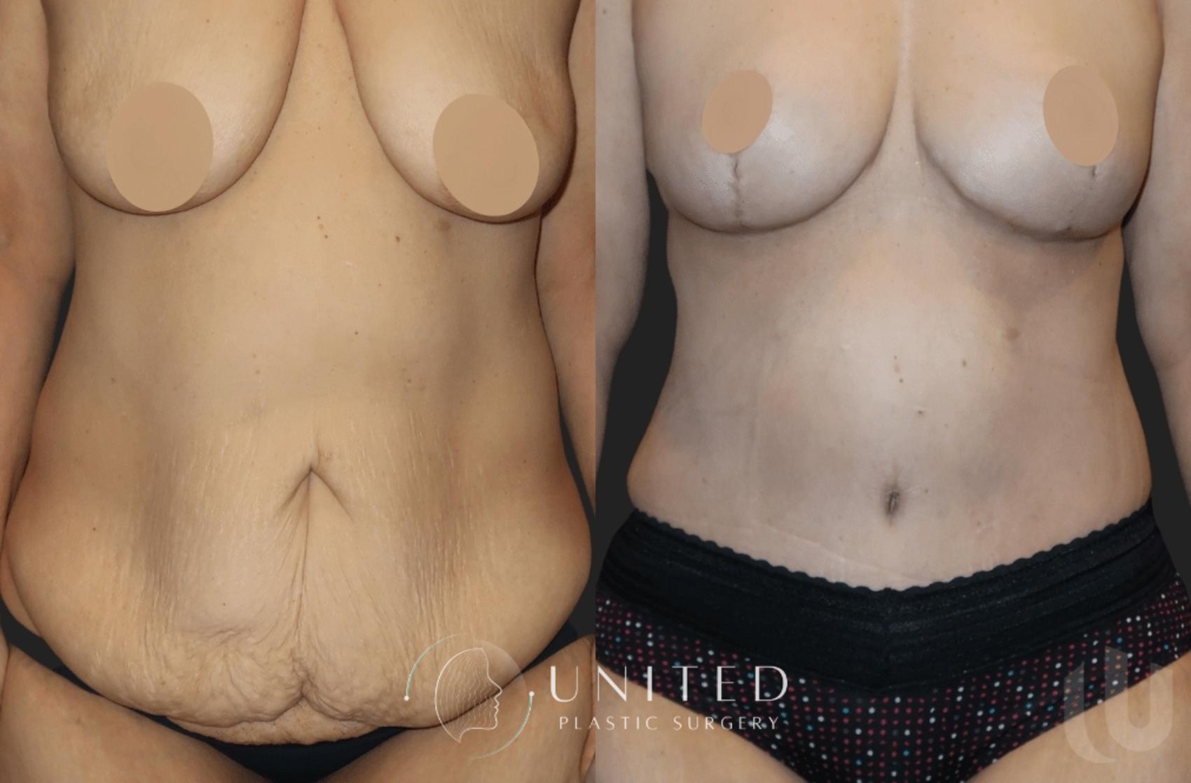 Before & After Tummy Tuck Case 11 Front View in Newport Beach, Temecula, & Orange County, California