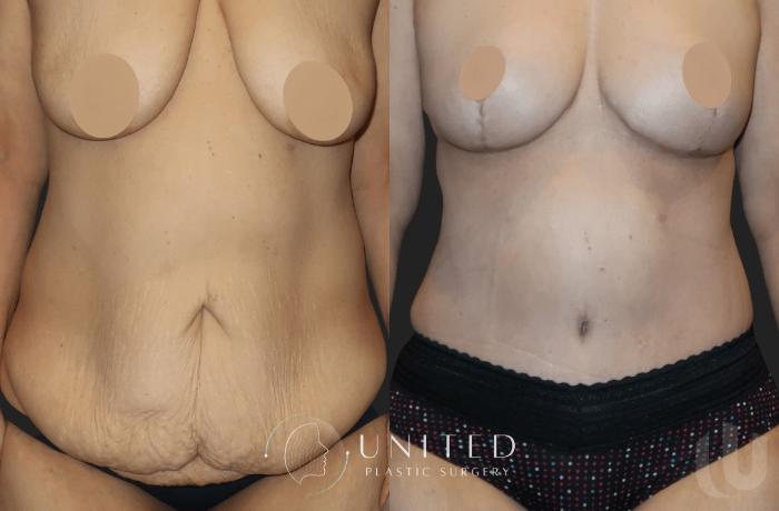 Before & After Breast Lift Case 11 Front View in Newport Beach, Temecula, & Orange County, California