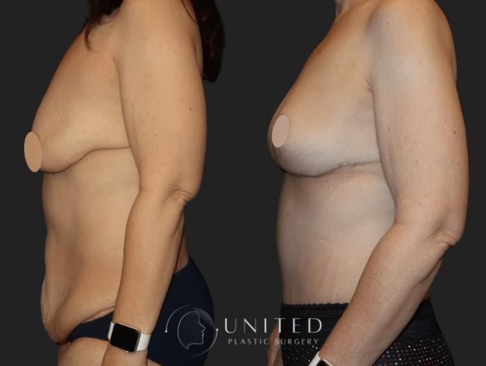 Before & After Tummy Tuck Case 11 Left Side View in Newport Beach, Temecula, & Orange County, California