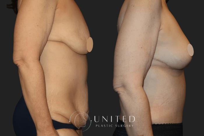 Before & After Tummy Tuck Case 11 Right Side View in Newport Beach, Temecula, & Orange County, California