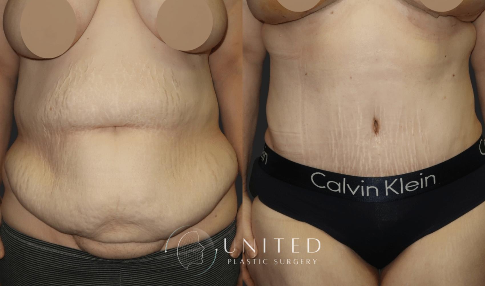 Before & After Tummy Tuck Case 14 Front View in Newport Beach, Temecula, & Orange County, California