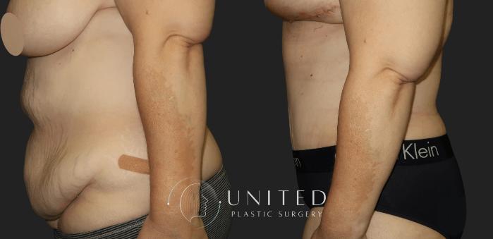 Before & After Tummy Tuck Case 14 Left Side View in Newport Beach, Temecula, & Orange County, California
