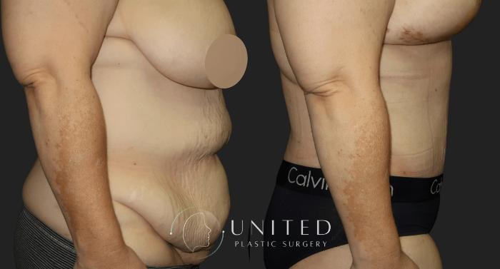 Before & After Tummy Tuck Case 14 Right Side View in Newport Beach, Temecula, & Orange County, California