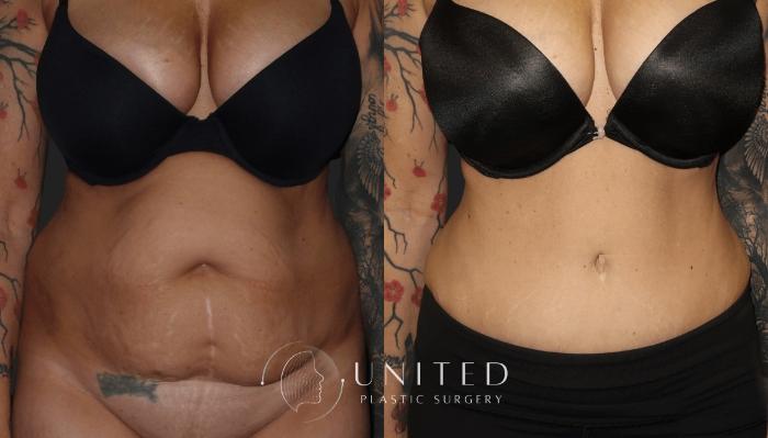 Before & After Liposuction Case 16 Front View in Newport Beach, Temecula, & Orange County, California