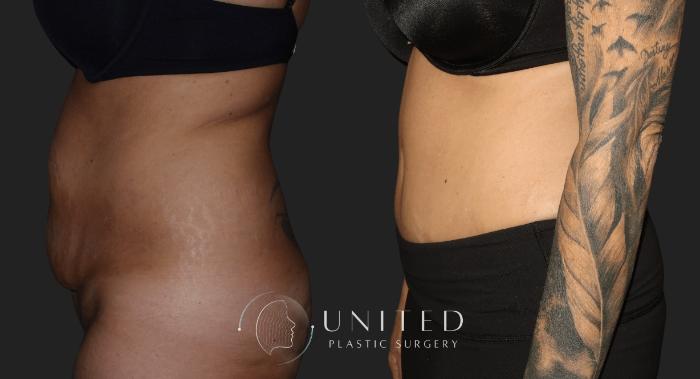Before & After Liposuction Case 16 Left Side View in Newport Beach, Temecula, & Orange County, California