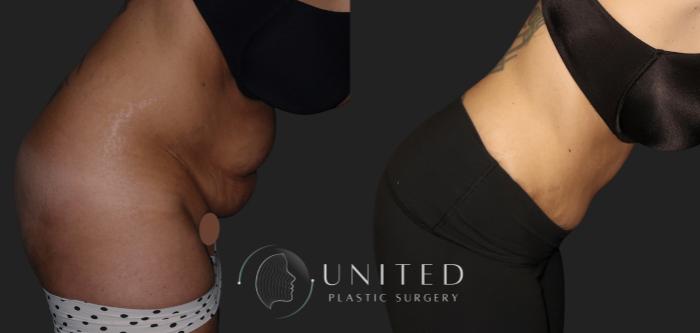 Before & After Tummy Tuck Case 16 Right Side Bent At Waist View in Newport Beach, Temecula, & Orange County, California