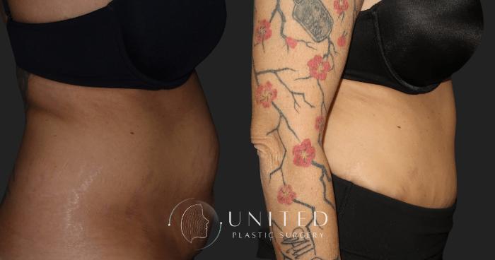 How Soon After a Tummy Tuck Can you Have a Tattoo  YouTube