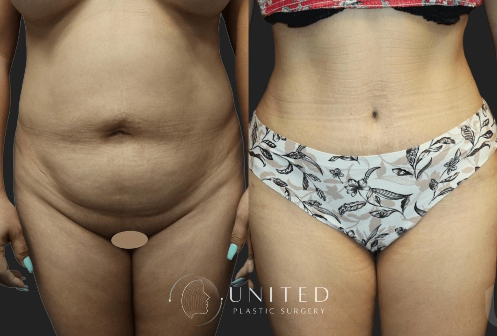 Before & After Tummy Tuck Case 17 Front View in Newport Beach, Temecula, & Orange County, California