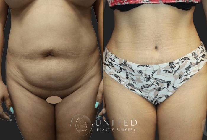 Before & After Reconstructive Plastic Surgery Case 17 Front View in Newport Beach, Temecula, & Orange County, California