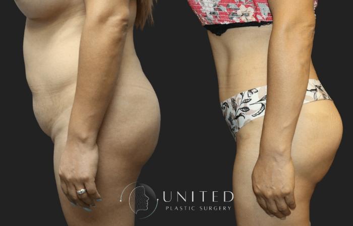 Before & After Reconstructive Plastic Surgery Case 17 Left Side View in Newport Beach, Temecula, & Orange County, California