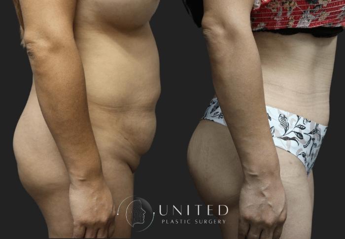 Before & After Tummy Tuck Case 17 Right Side View in Newport Beach, Temecula, & Orange County, California