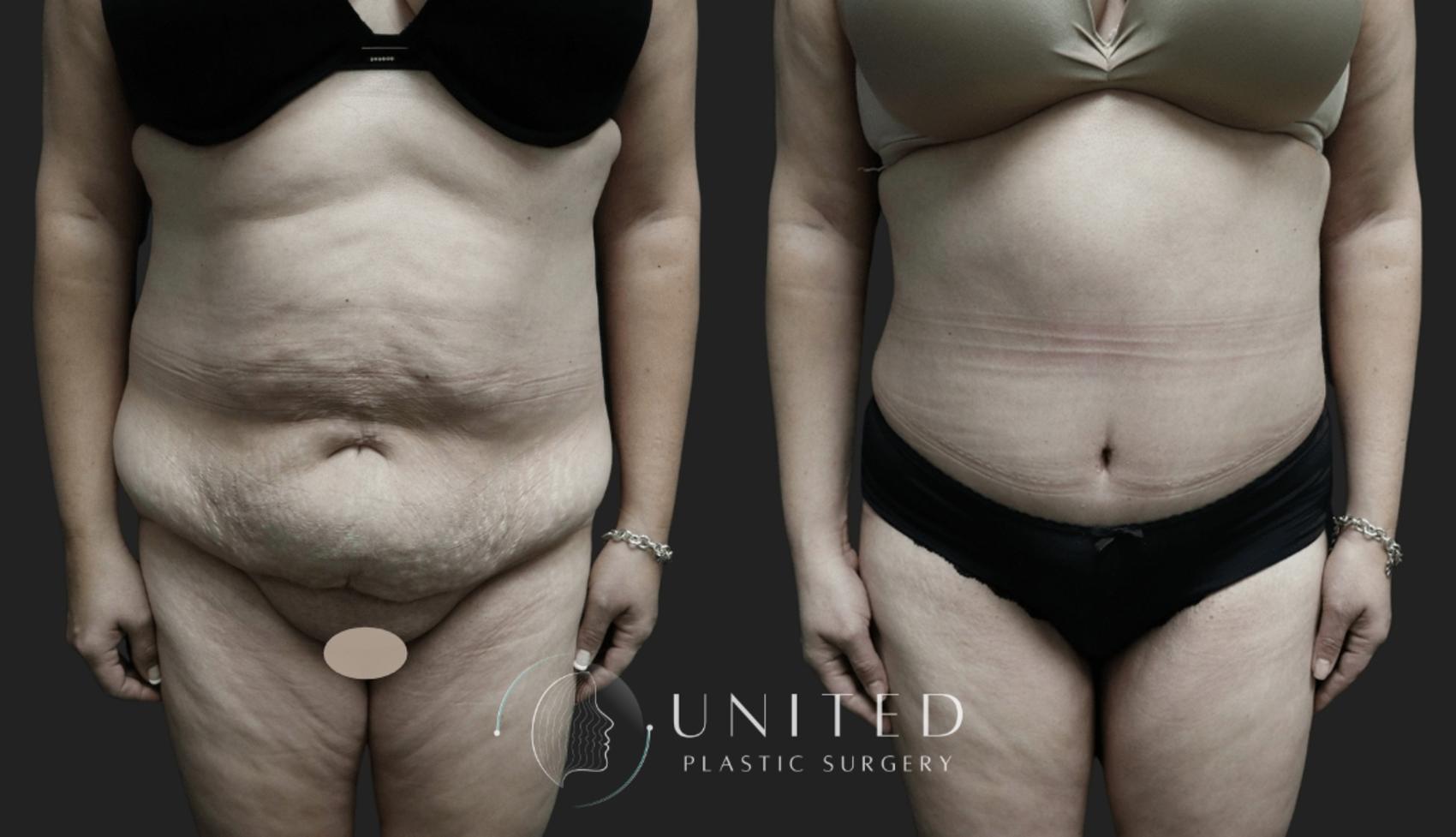 Before & After Tummy Tuck Case 7 Front View in Newport Beach, Temecula, & Orange County, California