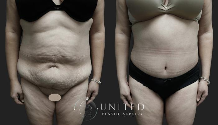 Before & After Liposuction Case 7 Front View in Newport Beach, Temecula, & Orange County, California