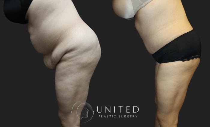 Before & After Tummy Tuck Case 7 Left Side Bent At Waist View in Newport Beach, Temecula, & Orange County, California