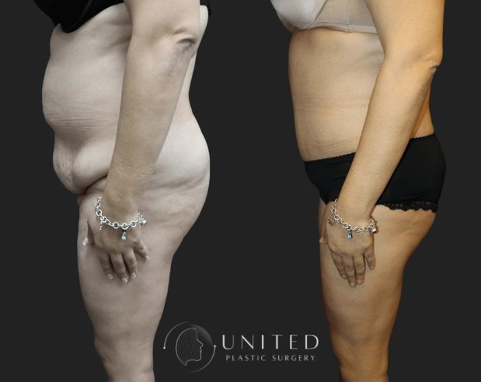 Before & After Tummy Tuck Case 7 Left Side View in Newport Beach, Temecula, & Orange County, California