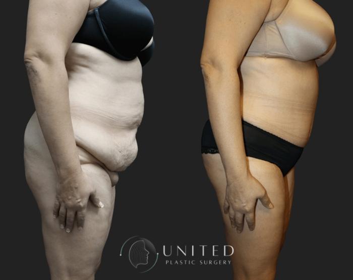 Before & After Liposuction Case 7 Right Side View in Newport Beach, Temecula, & Orange County, California